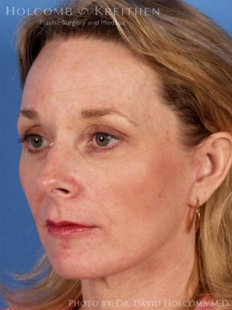 Energy Assisted Face/Neck Lift Before & After Gallery - Patient 282061 - Image 4
