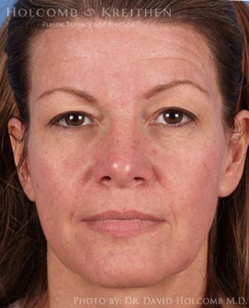 Neck Contouring Before & After Gallery - Patient 312506 - Image 1