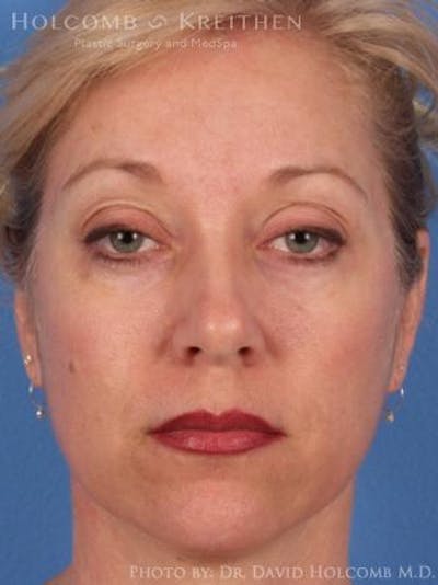 Energy Assisted Face/Neck Lift Before & After Gallery - Patient 297640 - Image 1