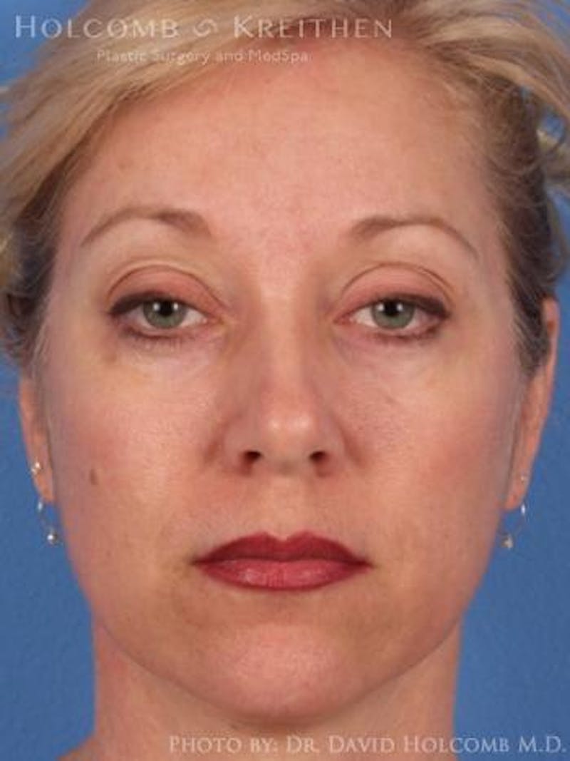 Neck Contouring Before & After Gallery - Patient 319627 - Image 1