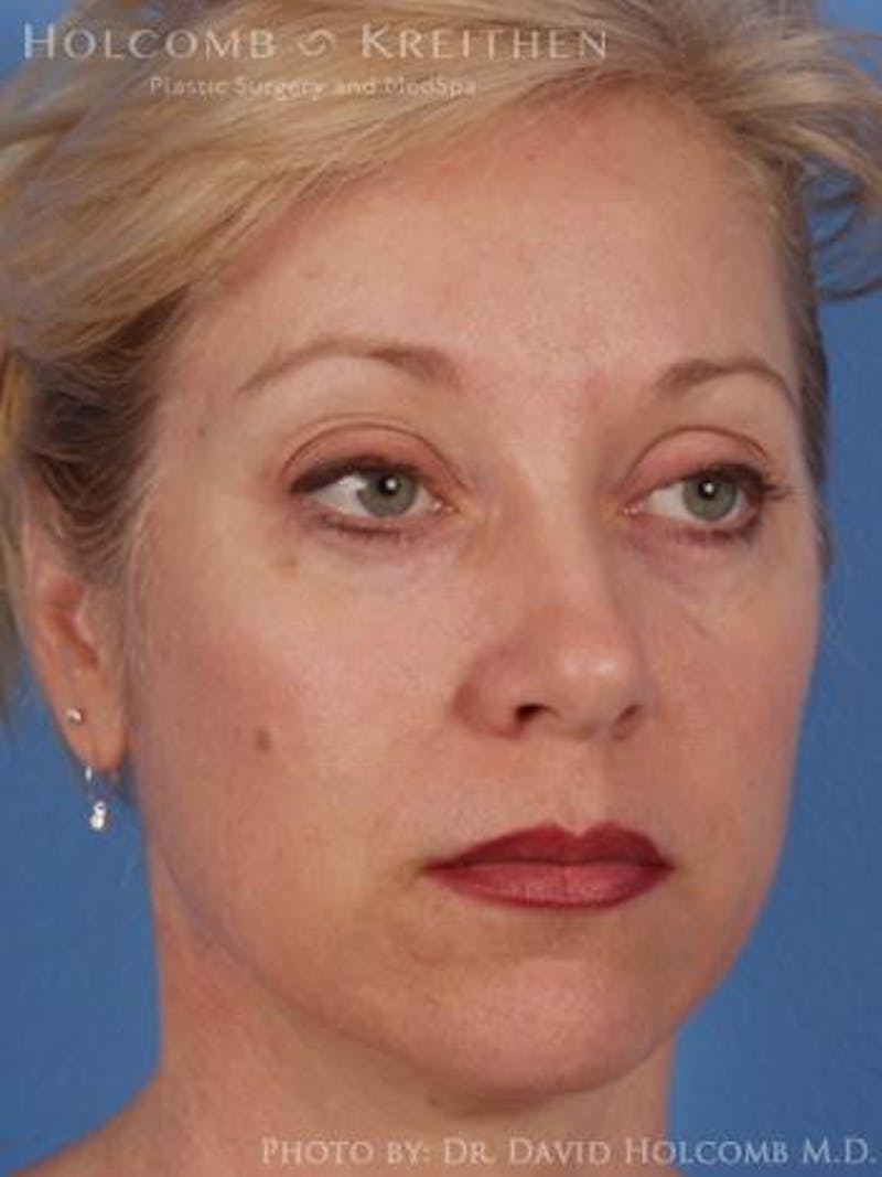 Neck Contouring Before & After Gallery - Patient 319627 - Image 3