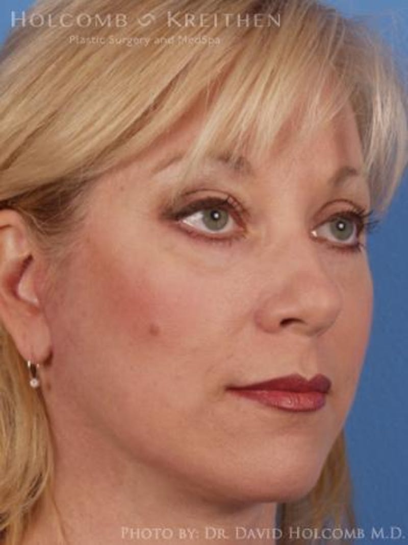 Neck Contouring Before & After Gallery - Patient 319627 - Image 4