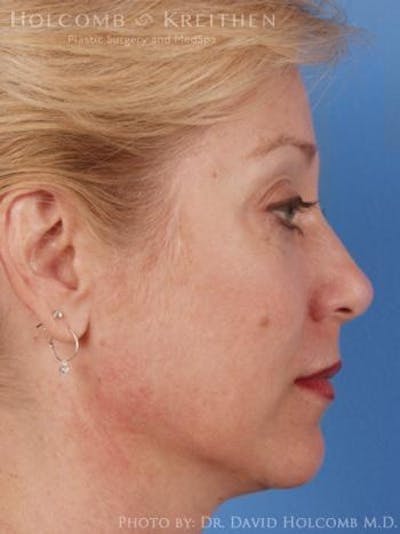Neck Contouring Before & After Gallery - Patient 319627 - Image 1