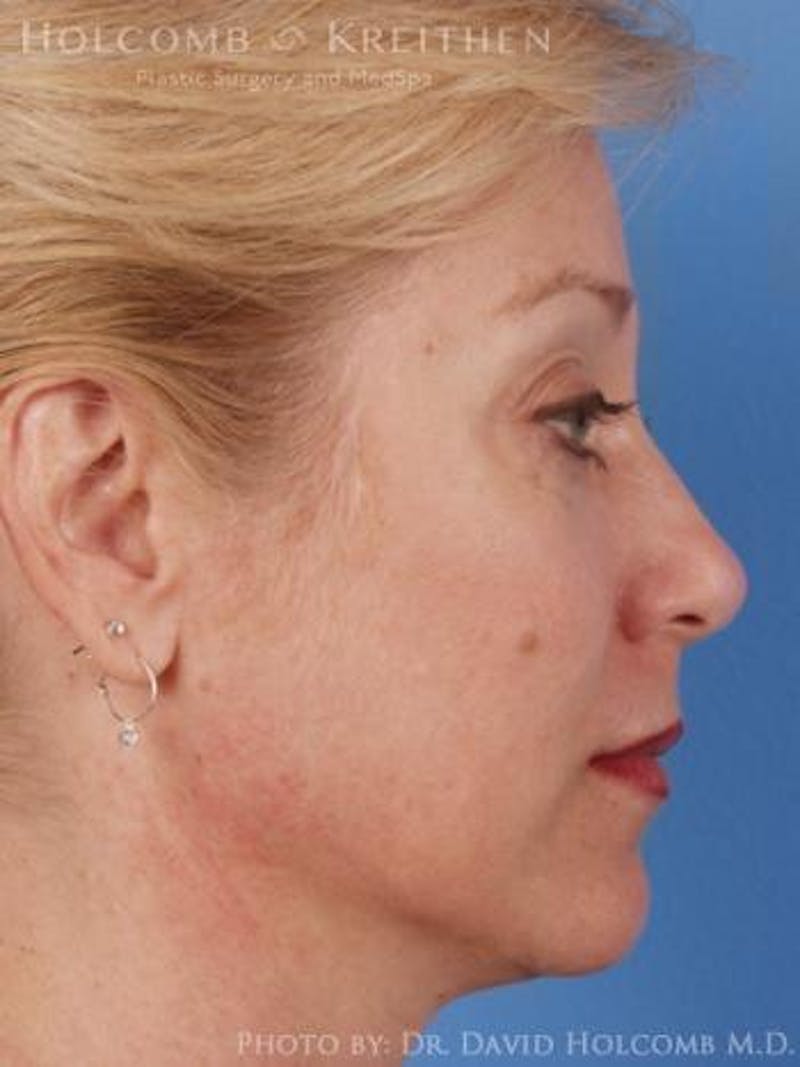 Neck Contouring Before & After Gallery - Patient 319627 - Image 5