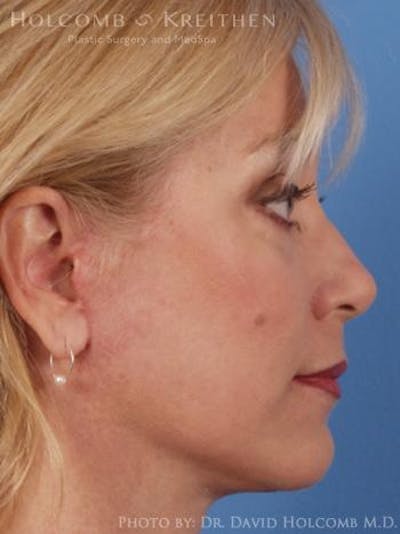 Neck Contouring Before & After Gallery - Patient 319627 - Image 2