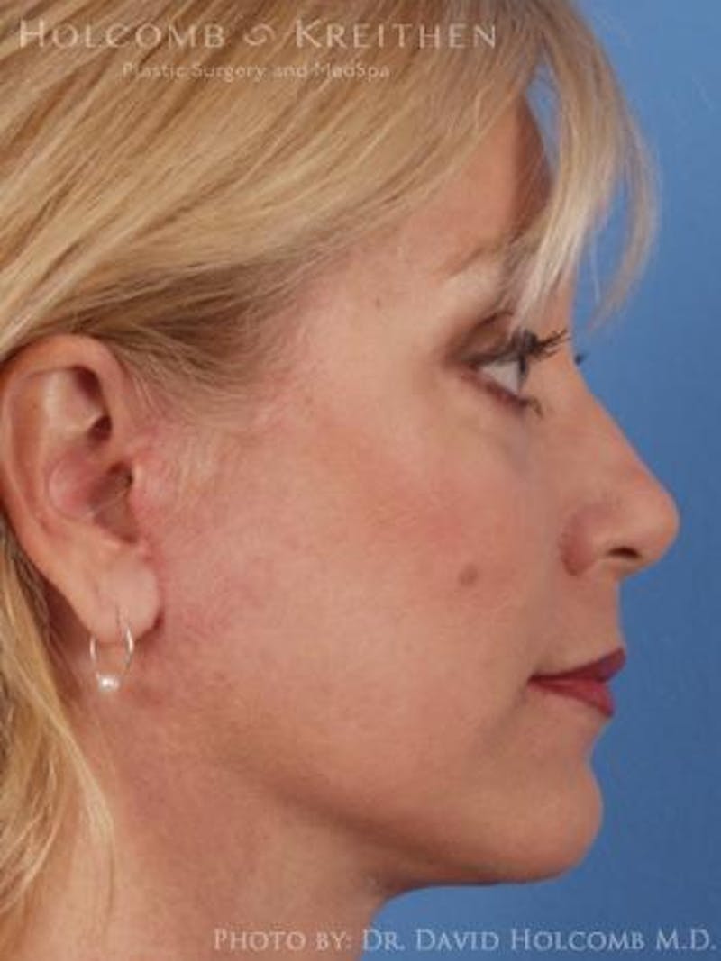 Neck Contouring Before & After Gallery - Patient 319627 - Image 6