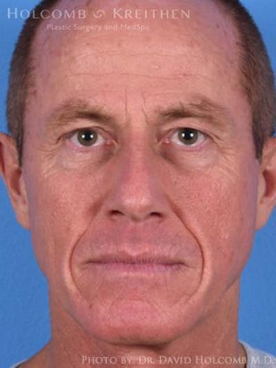 Energy Assisted Face/Neck Lift Before & After Gallery - Patient 160086 - Image 1
