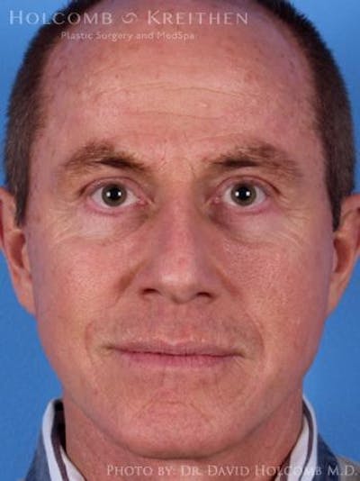 Energy Assisted Face/Neck Lift Before & After Gallery - Patient 160086 - Image 2