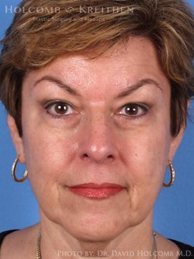 Energy Assisted Face/Neck Lift Before & After Gallery - Patient 377529 - Image 1