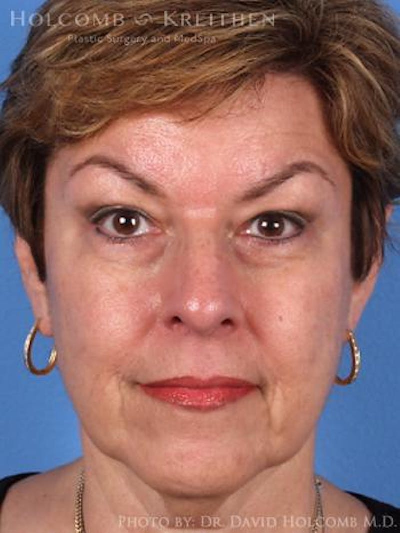 Neck Contouring Before & After Gallery - Patient 632018 - Image 3