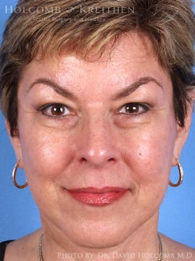 Energy Assisted Face/Neck Lift Before & After Gallery - Patient 377529 - Image 2