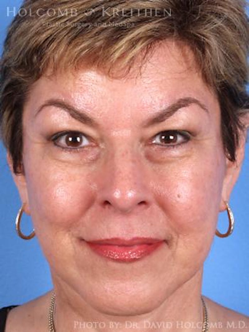 Neck Contouring Before & After Gallery - Patient 632018 - Image 4