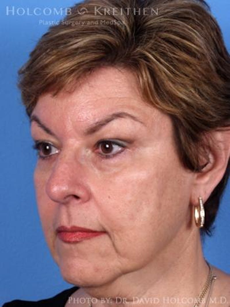 Neck Contouring Before & After Gallery - Patient 632018 - Image 5
