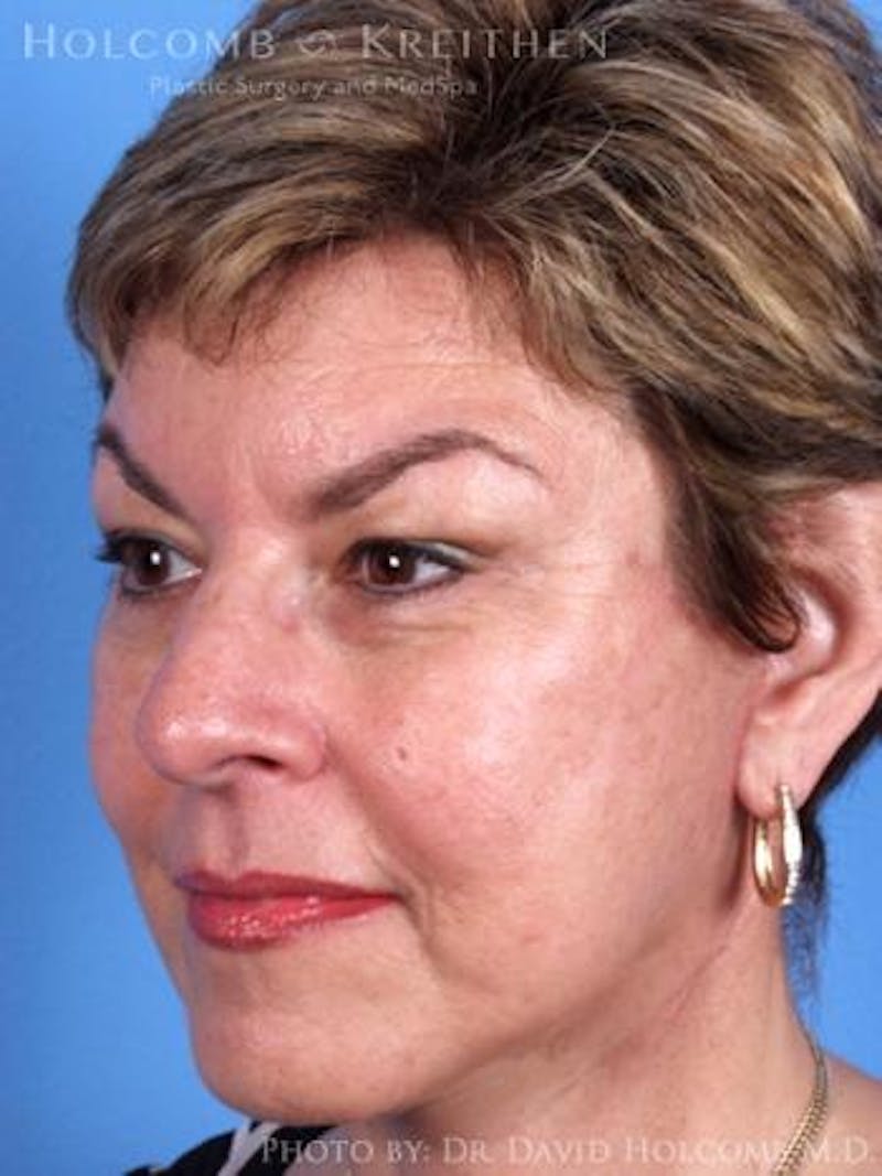 Neck Contouring Before & After Gallery - Patient 632018 - Image 6