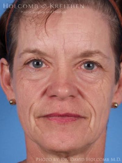 Energy Assisted Face/Neck Lift Before & After Gallery - Patient 155755 - Image 1