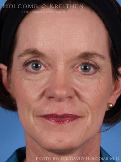 Energy Assisted Face/Neck Lift Before & After Gallery - Patient 155755 - Image 2
