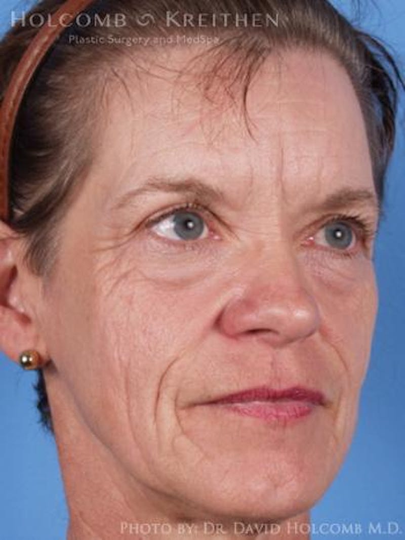 Neck Contouring Before & After Gallery - Patient 118890 - Image 5