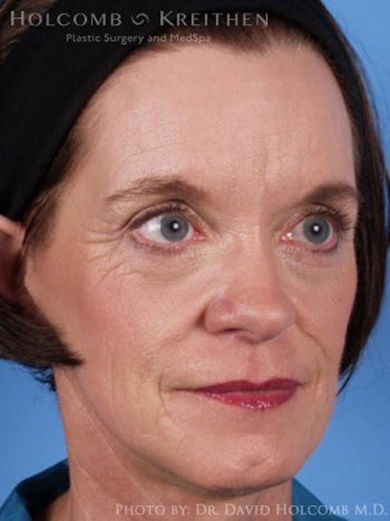 Neck Contouring Before & After Gallery - Patient 118890 - Image 6