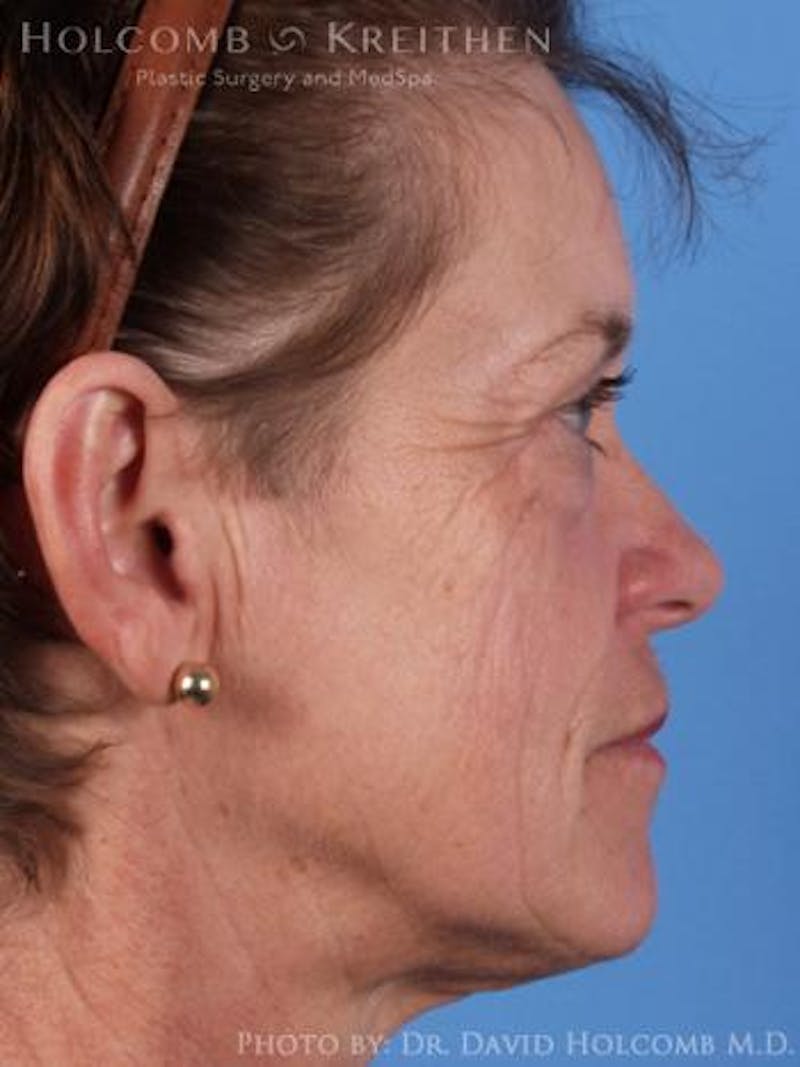 Neck Contouring Before & After Gallery - Patient 118890 - Image 1