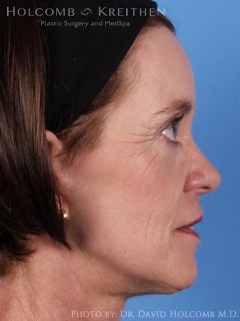 Neck Contouring Before & After Gallery - Patient 118890 - Image 2