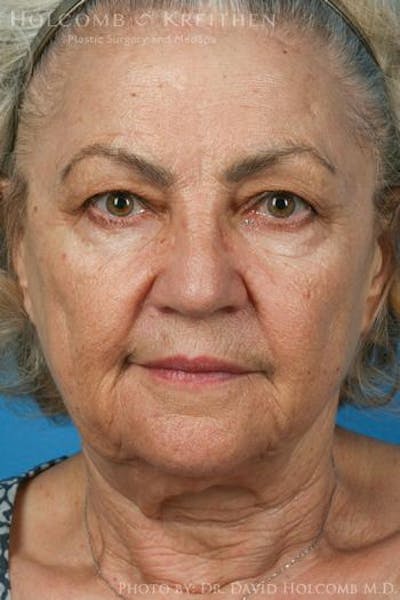 Energy Assisted Face/Neck Lift Before & After Gallery - Patient 395656 - Image 1