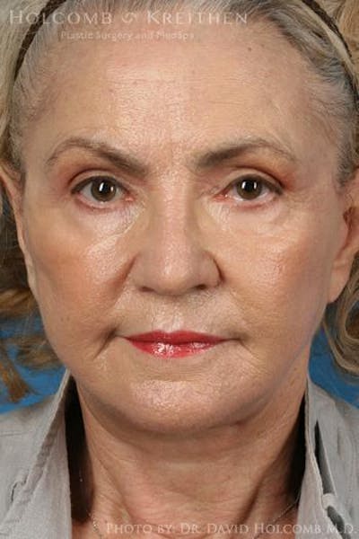 Energy Assisted Face/Neck Lift Before & After Gallery - Patient 395656 - Image 2
