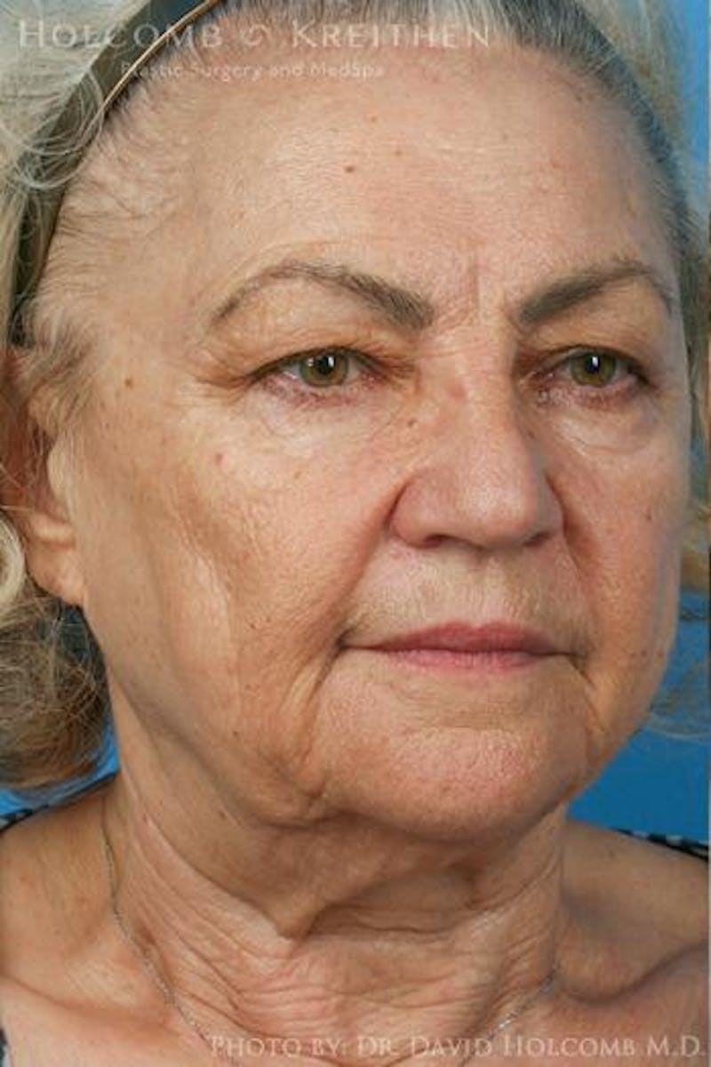 Energy Assisted Face/Neck Lift Before & After Gallery - Patient 395656 - Image 3
