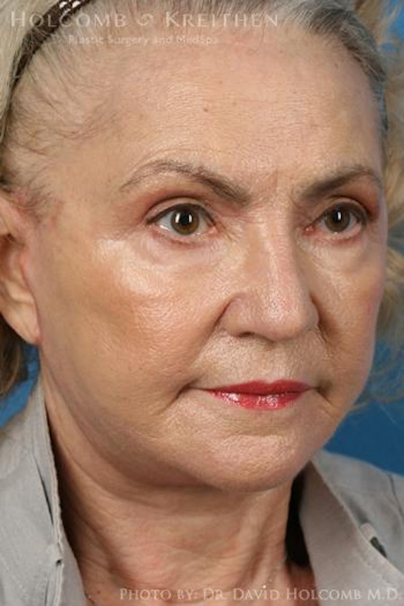 Energy Assisted Face/Neck Lift Before & After Gallery - Patient 395656 - Image 4