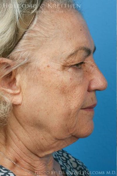 Neck Contouring Before & After Gallery - Patient 260391 - Image 1