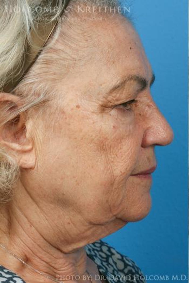 Energy Assisted Face/Neck Lift Before & After Gallery - Patient 395656 - Image 5