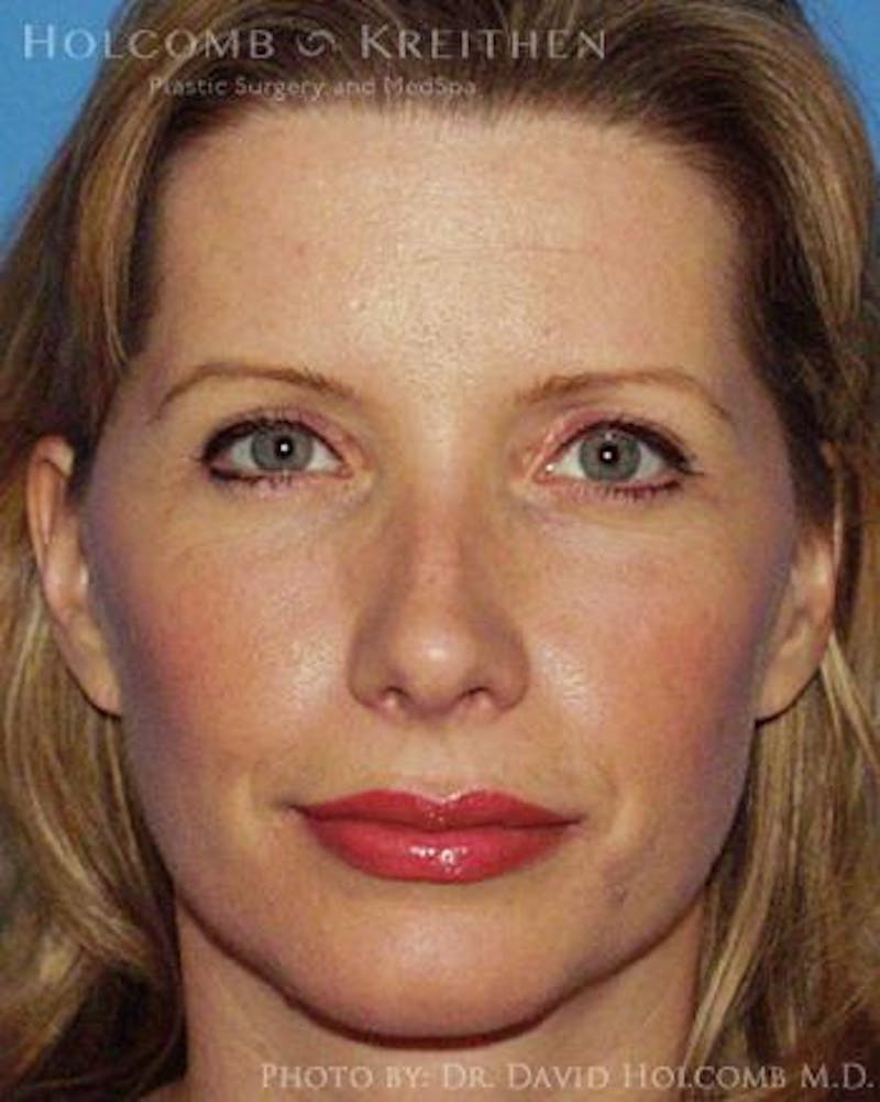 Neck Contouring Before & After Gallery - Patient 547031 - Image 2