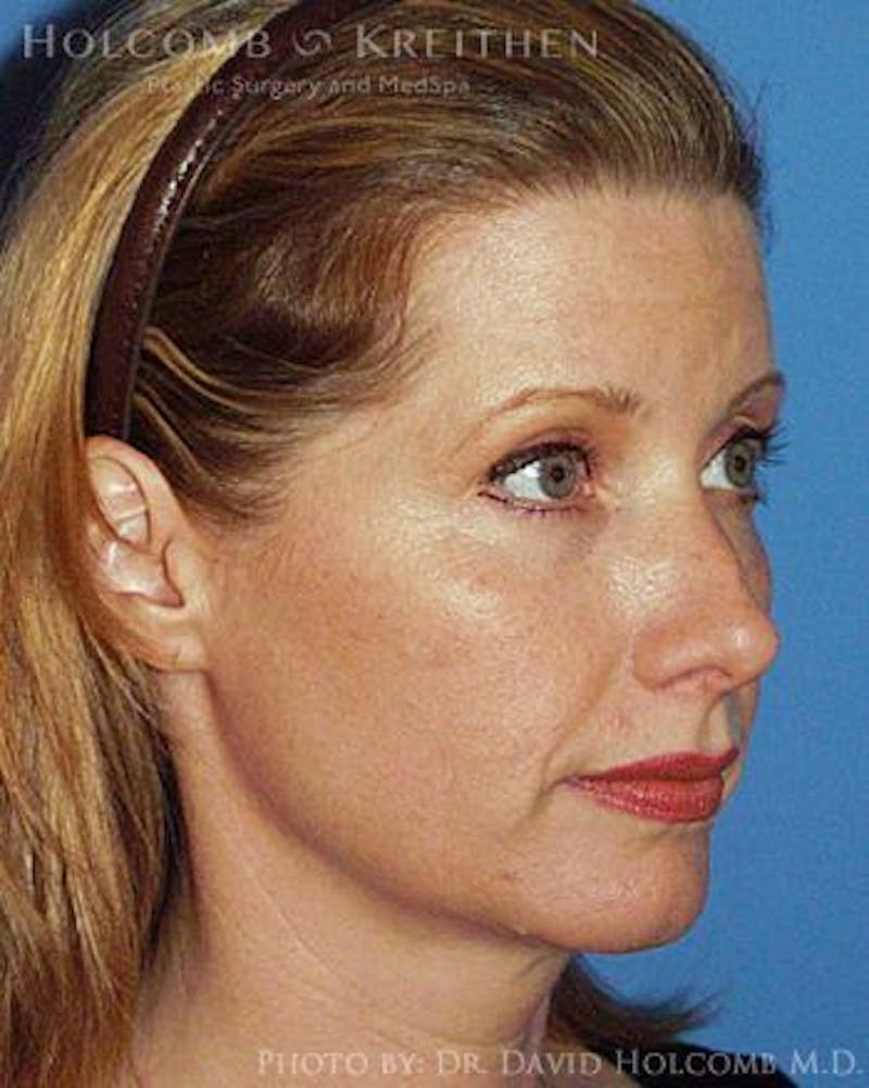 Neck Contouring Before & After Gallery - Patient 547031 - Image 3