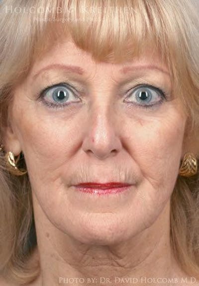 Energy Assisted Face/Neck Lift Before & After Gallery - Patient 235546 - Image 1