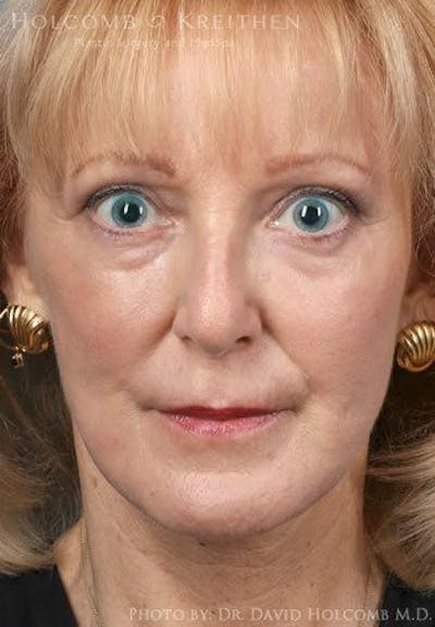 Energy Assisted Face/Neck Lift Before & After Gallery - Patient 235546 - Image 2