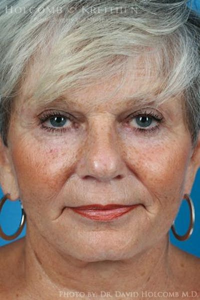 Energy Assisted Face/Neck Lift Before & After Gallery - Patient 977463 - Image 2
