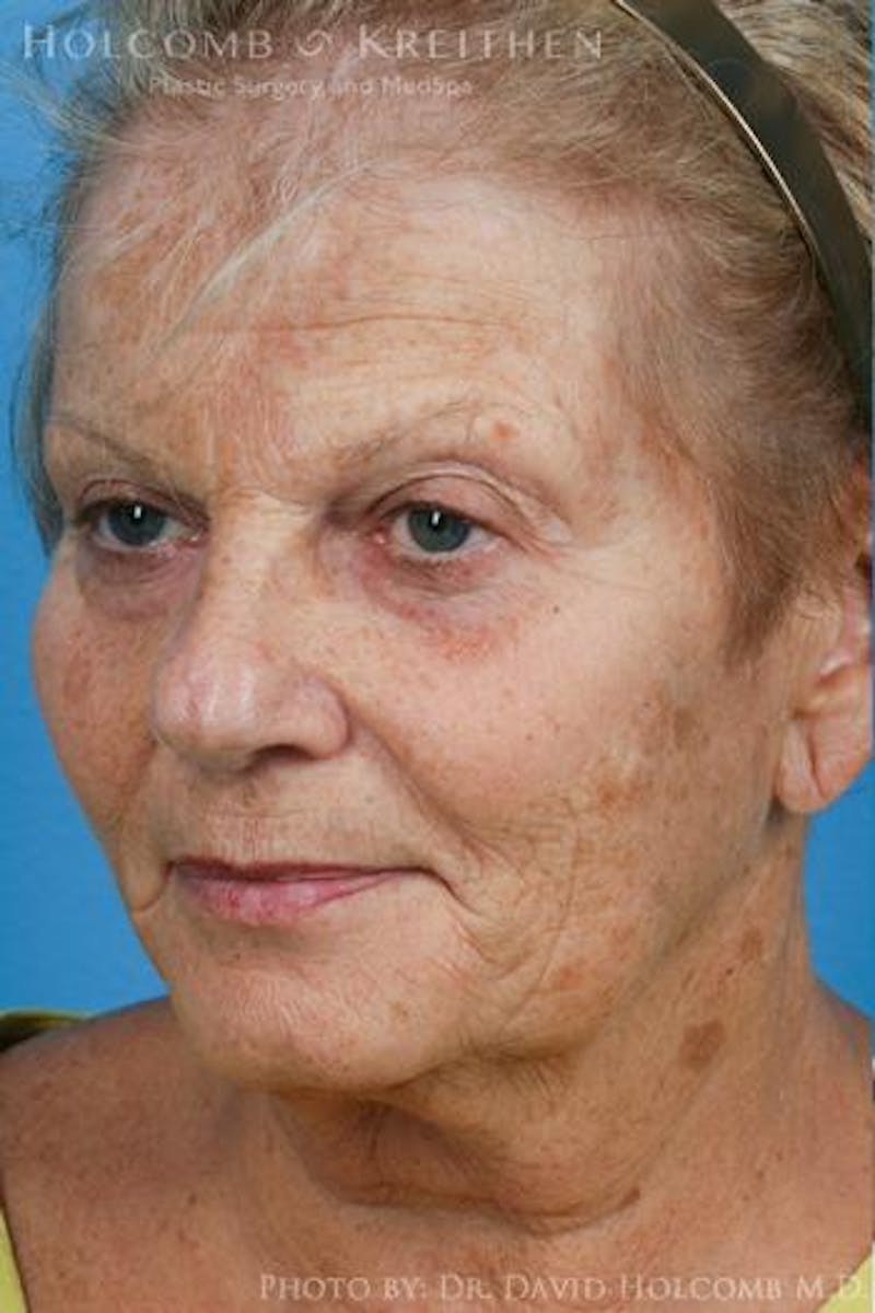 Neck Contouring Before & After Gallery - Patient 550178 - Image 5