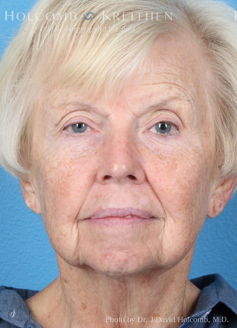 Energy Assisted Face/Neck Lift Before & After Gallery - Patient 361345 - Image 1