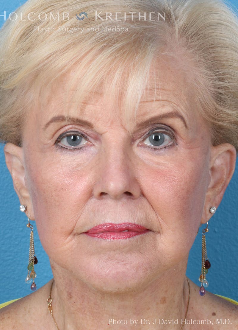 Energy Assisted Face/Neck Lift Before & After Gallery - Patient 361345 - Image 2