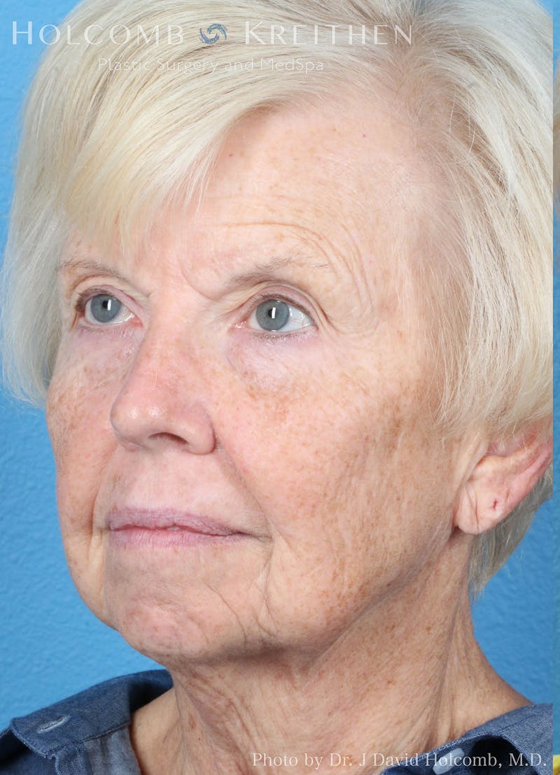 Energy Assisted Face/Neck Lift Before & After Gallery - Patient 361345 - Image 3