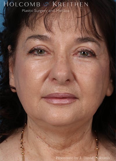 Energy Assisted Face/Neck Lift Before & After Gallery - Patient 404398 - Image 1