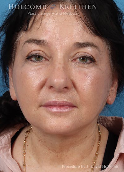 Energy Assisted Face/Neck Lift Before & After Gallery - Patient 404398 - Image 2