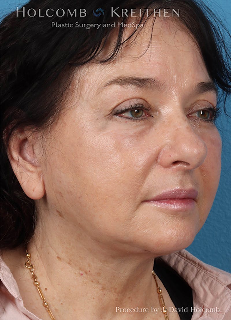 Energy Assisted Face/Neck Lift Before & After Gallery - Patient 404398 - Image 4