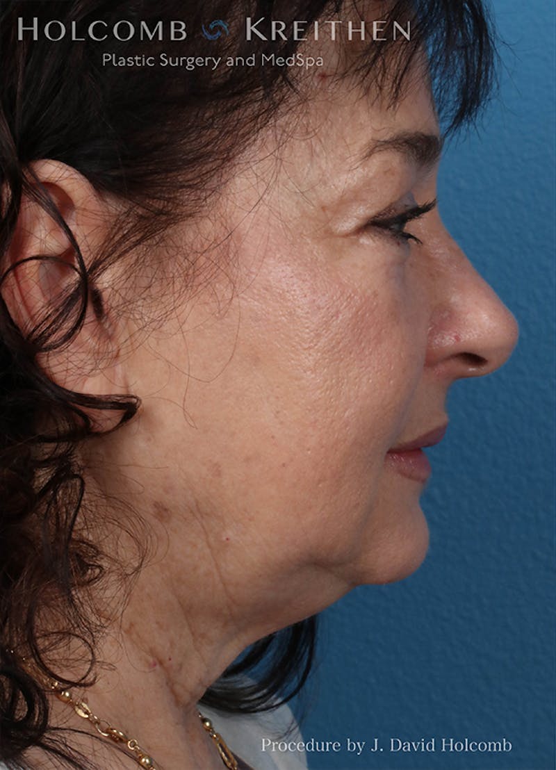 Energy Assisted Face/Neck Lift Before & After Gallery - Patient 404398 - Image 5