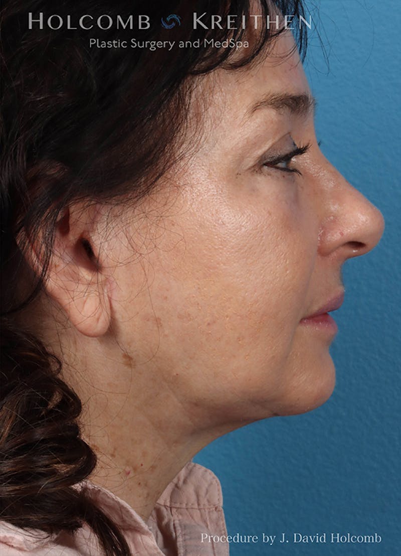 Energy Assisted Face/Neck Lift Before & After Gallery - Patient 404398 - Image 6