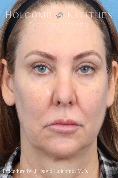 Energy Assisted Face/Neck Lift Before & After Gallery - Patient 132868 - Image 1