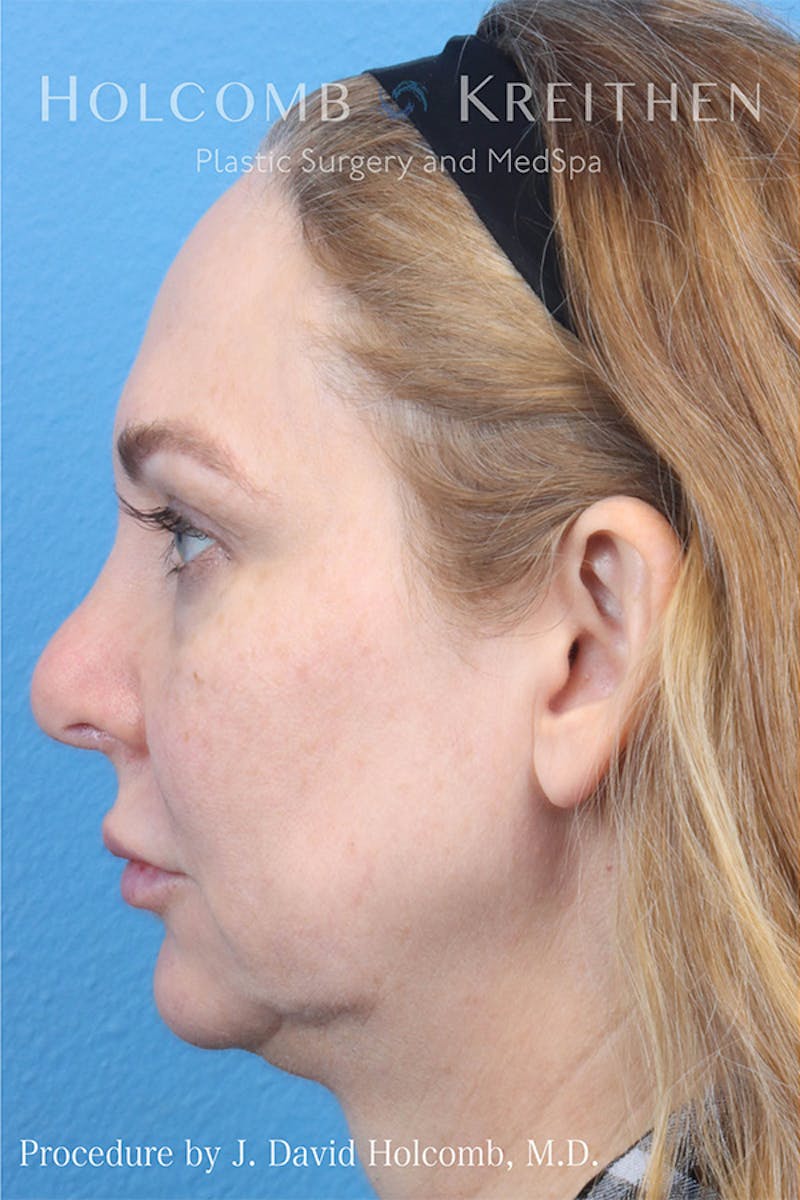 Energy Assisted Face/Neck Lift Before & After Gallery - Patient 132868 - Image 3