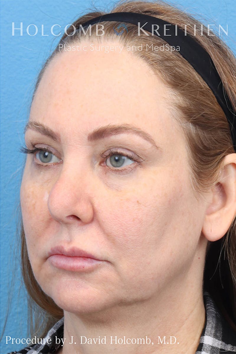 Energy Assisted Face/Neck Lift Before & After Gallery - Patient 132868 - Image 5