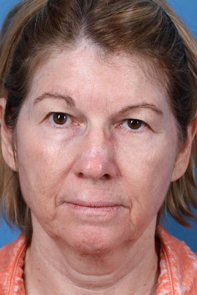 Energy Assisted Face/Neck Lift Before & After Gallery - Patient 390579 - Image 1