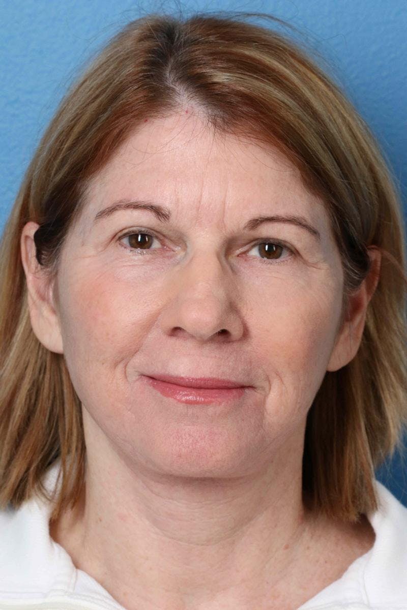 Energy Assisted Face/Neck Lift Before & After Gallery - Patient 390579 - Image 2