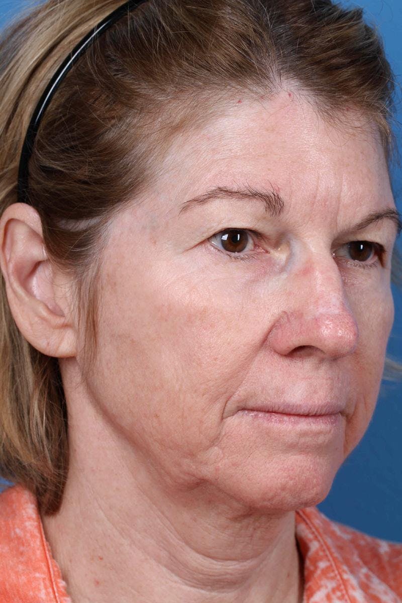 Energy Assisted Face/Neck Lift Before & After Gallery - Patient 390579 - Image 3